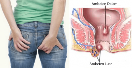 Cara Alami Mengobati Ambien