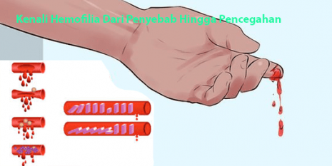Kenali Hemofilia Dari Penyebab Hingga Pencegahan